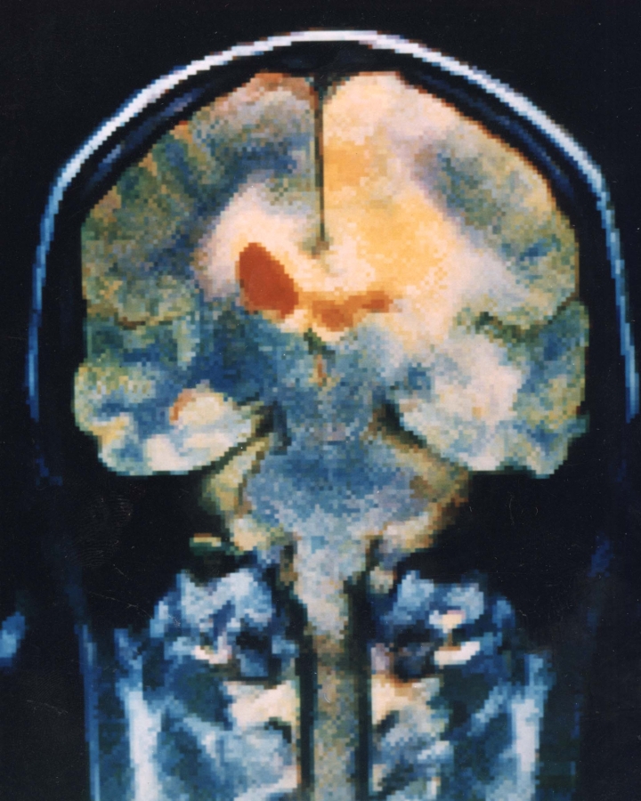 Early Brain Changes in Mental Health