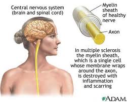 Potential Dangers of Multiple Sclerosis Treatment
