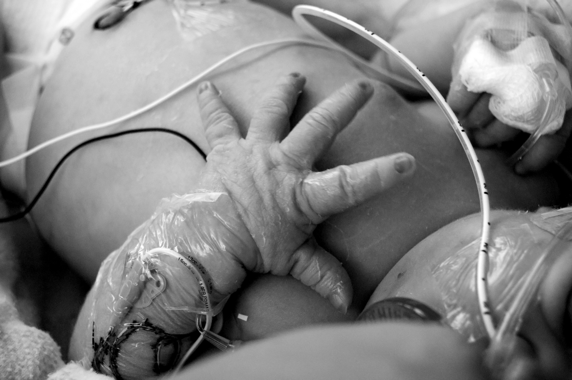 Preemie Breathing Treatment Ineffective