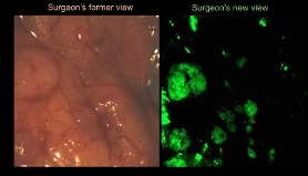 Lighting up Cancer Brightens Patient Futures