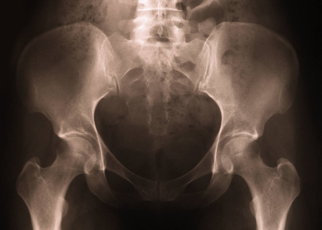 Risks for Hip Replacement Do-Overs