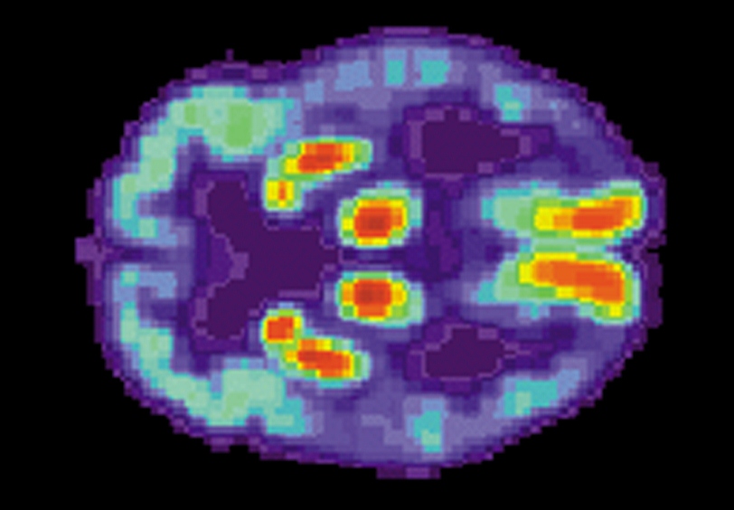 Memory Loss - Plaques or Genes?