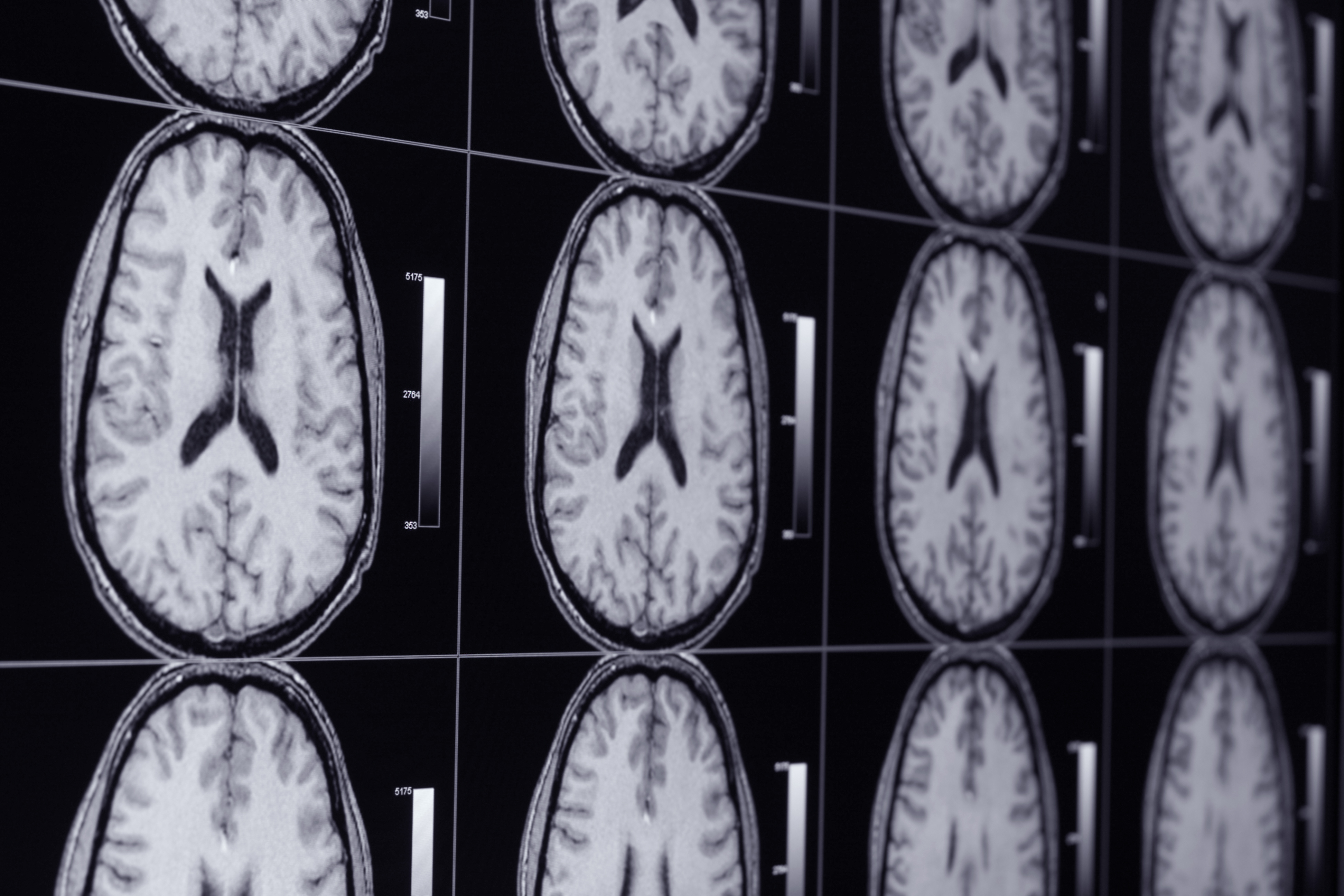 Hyperactive Brain Related to Depression