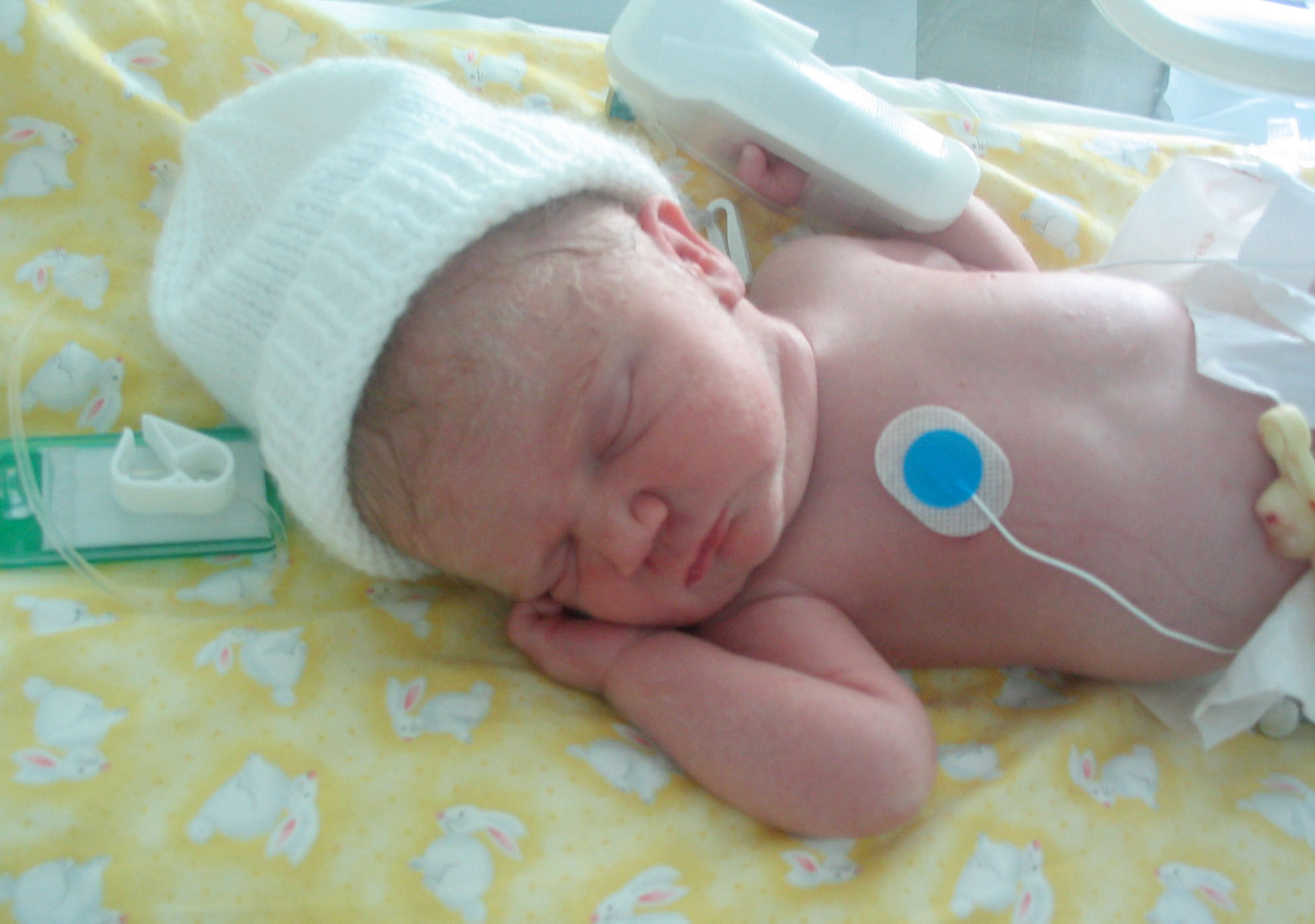 Head-First Preemie Birth Okay Either Way