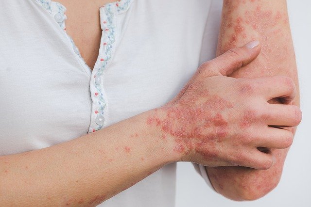 Psoriasis 101