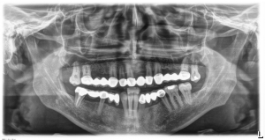 Reducing Tooth Decay in Children