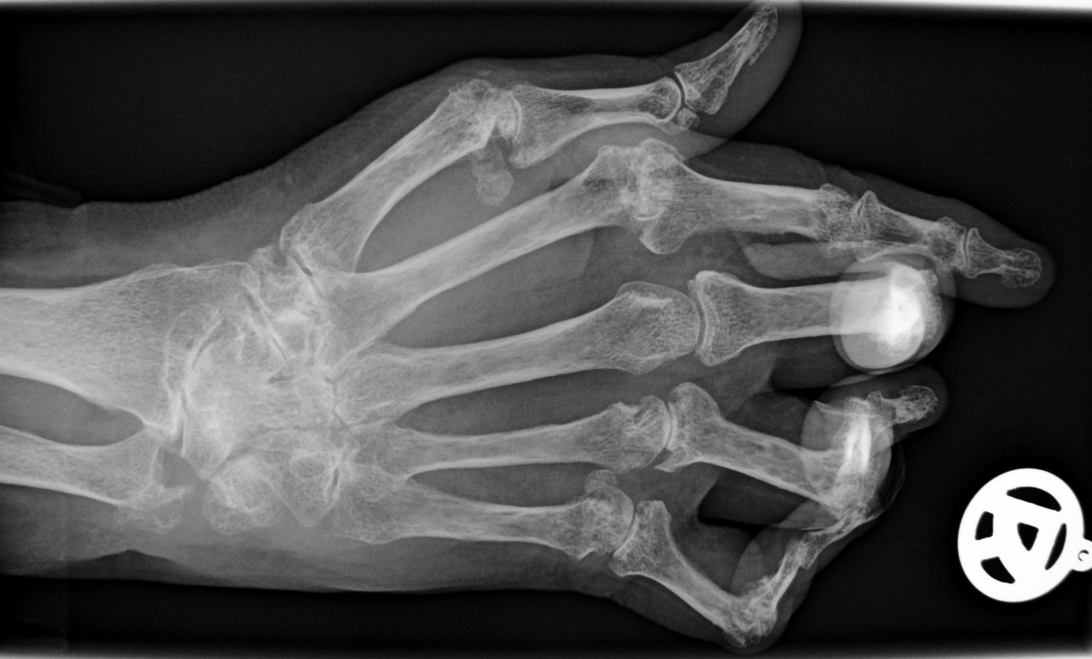 Facts About Rheumatoid Arthritis
