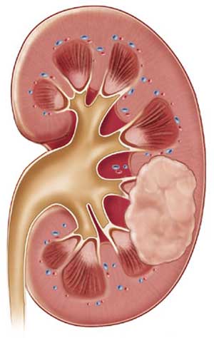 Pfizer Reports Results From Torisel Study 