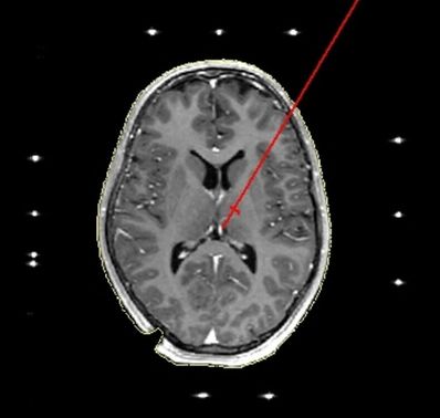 Deep Brain Stimulation Could Treat Severe Depression
