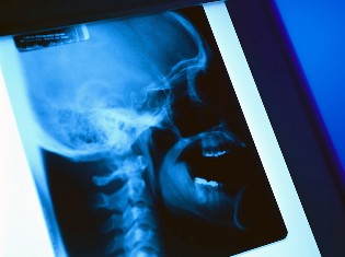 Making Headway Against Head & Neck Cancers