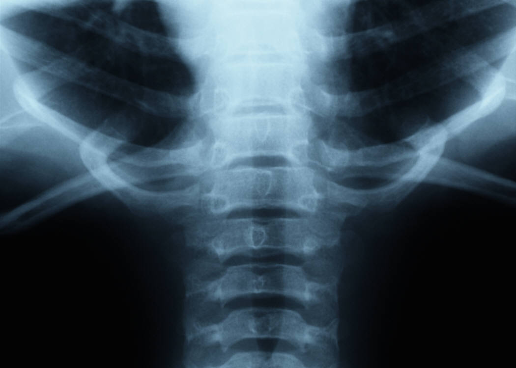 The Trade-Offs of Spinal Surgeries