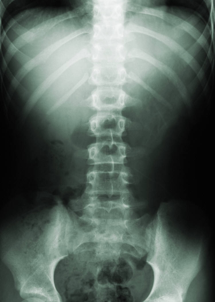 Is Exercise Best for Low Back Pain?