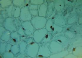 Overcoming Transplant Rejection