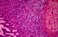 Sunlight, Vitamin D, and Crohn's Disease