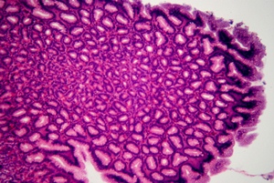 Childhood Cancer Warriors at Higher Risk of GI Cancers