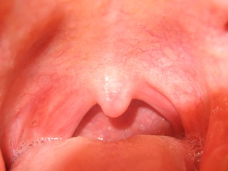 HPV-Related Throat Cancers Fare Better