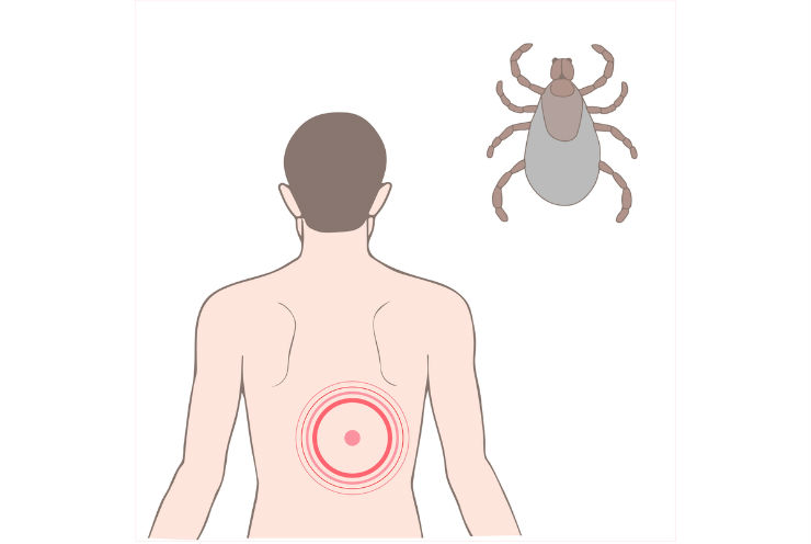 Tick Season Means Lyme Disease