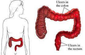 Abbott Drug Gets Positive Review in Ulcerative Colitis