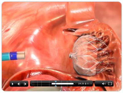 Technology Protects Arrhythmia Patients