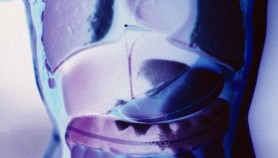 Urine Test for Cancer in the Works