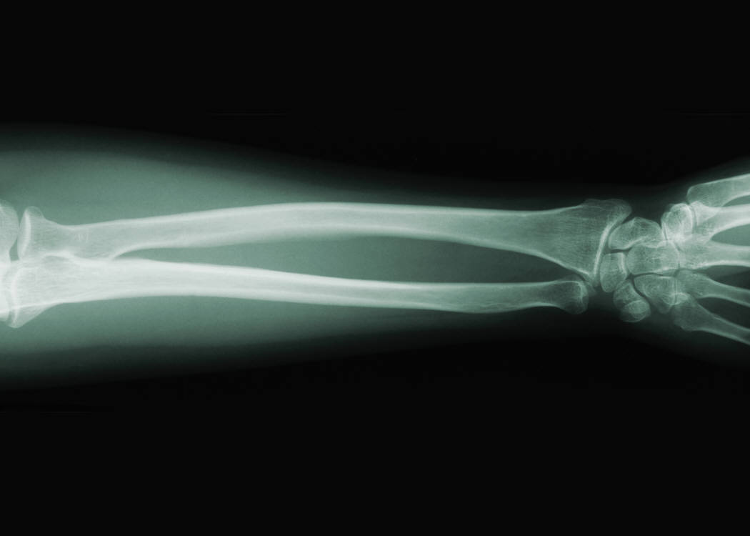 FDA Approves Xgeva