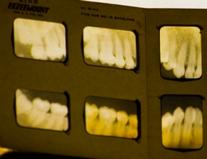 Dental X-rays Increase Brain Cancer Risks