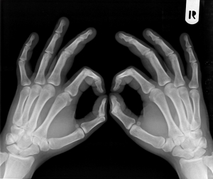 Bone Rx may Break Uterine Cancer Risks