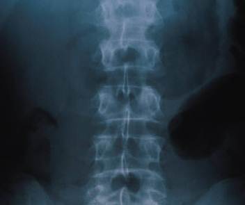No Bone Drug Better Than Another